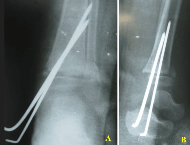 Postoperative radiographs in two planes (A, B) showing two smooth K-wires crossing the physis after reduction of an open paediatric distal tibial physeal fracture