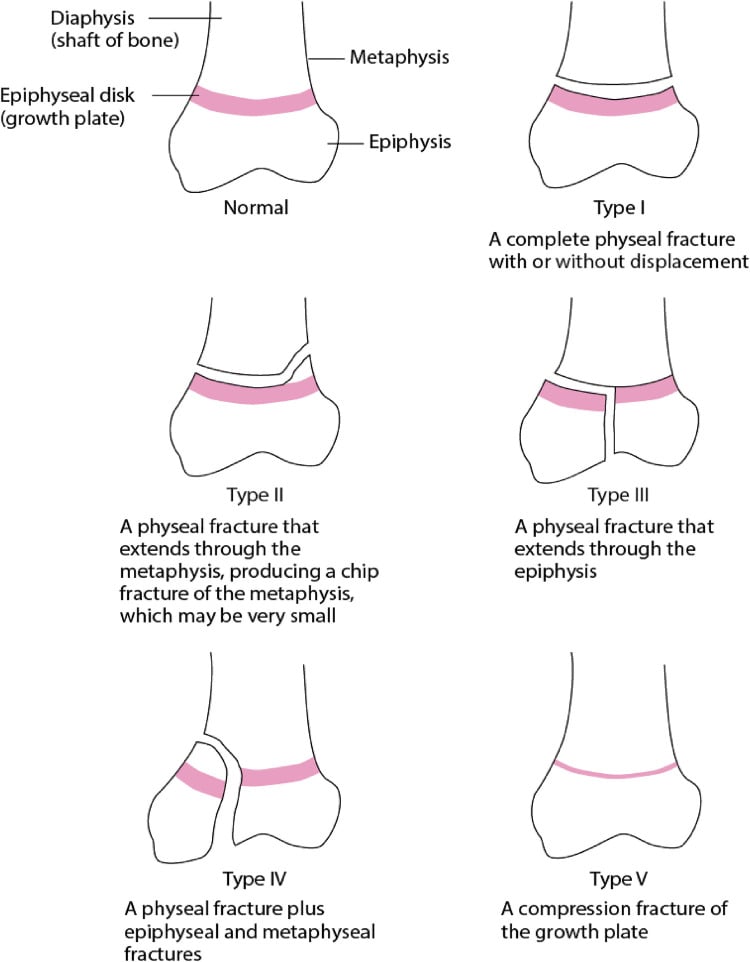 Labelled schematic of a normal physis and Salter-Harris types I to V drawn on a generic long-bone end