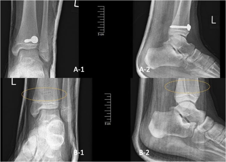 AP and lateral radiographs of two fixed paediatric distal tibial Salter-Harris II fractures, one with a metal screw (A-1, A-2) and one with radiolucent implants whose site is circled (B-1, B-2)
