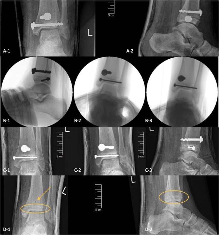 Distal tibial Salter-Harris IV fracture fixation: radiographs with metal screws (A, C), intra-operative fluoroscopy (B-1 to B-3) and radiographs with the fixation site circled (D-1, D-2)