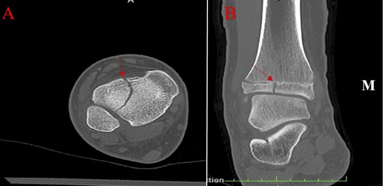 Axial (A) and coronal (B) CT of a juvenile Tillaux fracture, with arrows on the epiphyseal fracture line and M marking the medial side of the coronal image