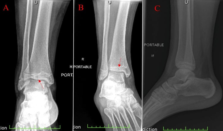 AP (A), internal-oblique (B) and lateral (C) ankle radiographs of a juvenile Tillaux fracture, with arrows on a subtle epiphyseal lucency in A and B