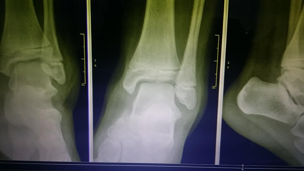 Tillaux Salter-Harris III distal tibial fracture radiograph series