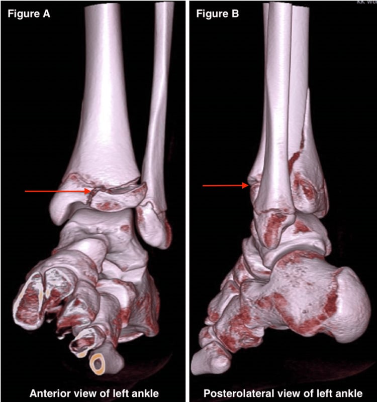 Three-dimensional CT reconstructions of a triplane fracture of the left ankle, anterior view (A) and posterolateral view (B), with arrows on the fracture