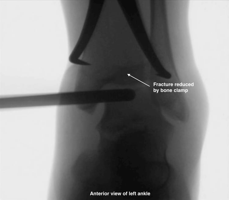 Anterior fluoroscopic view of the left ankle with a bone clamp holding a triplane fracture reduced