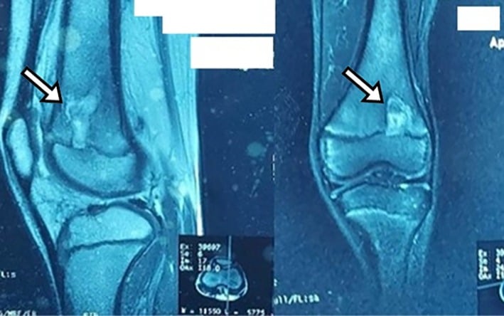 Sagittal and coronal contrast-enhanced knee MRI showing the penumbra sign around a distal femoral Brodie abscess.