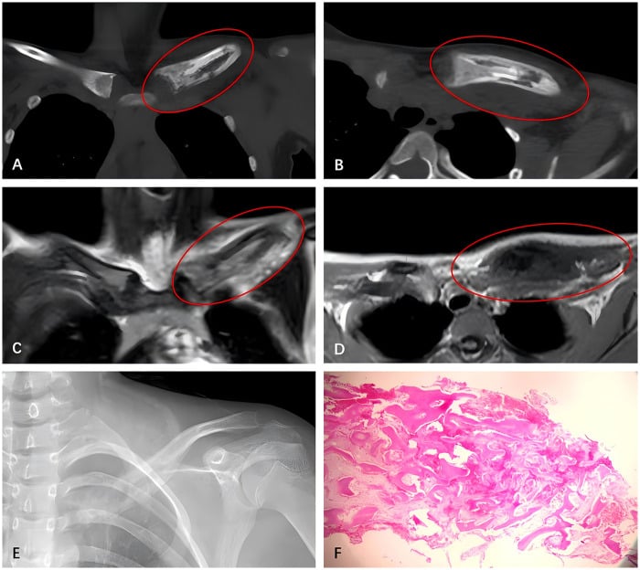 CT, MRI, radiograph and histology panel of chronic nonbacterial osteomyelitis affecting the left clavicle.