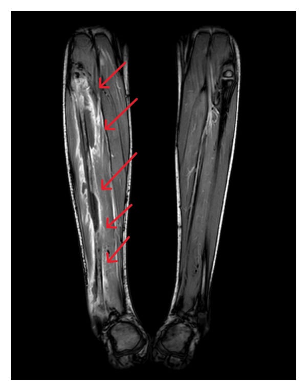Coronal post-contrast MRI of both lower legs showing a long rim-enhancing subperiosteal abscess along the right fibular diaphysis.