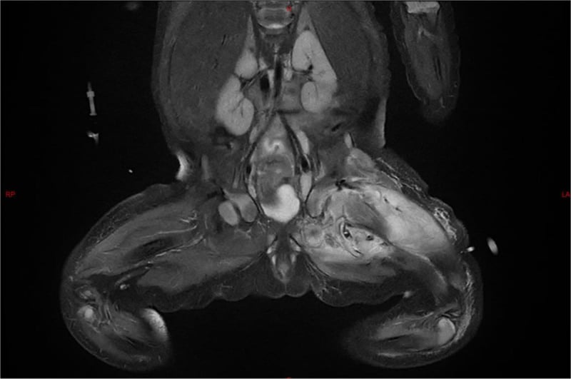Coronal MRI of a 24-day-old neonate showing left thigh abscess, femoral-head infection and hip-joint involvement.