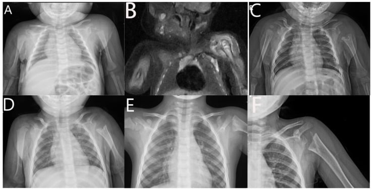 Serial shoulder radiographs and MRI in a neonate with humeral epiphyseal osteomyelitis and septic arthritis.