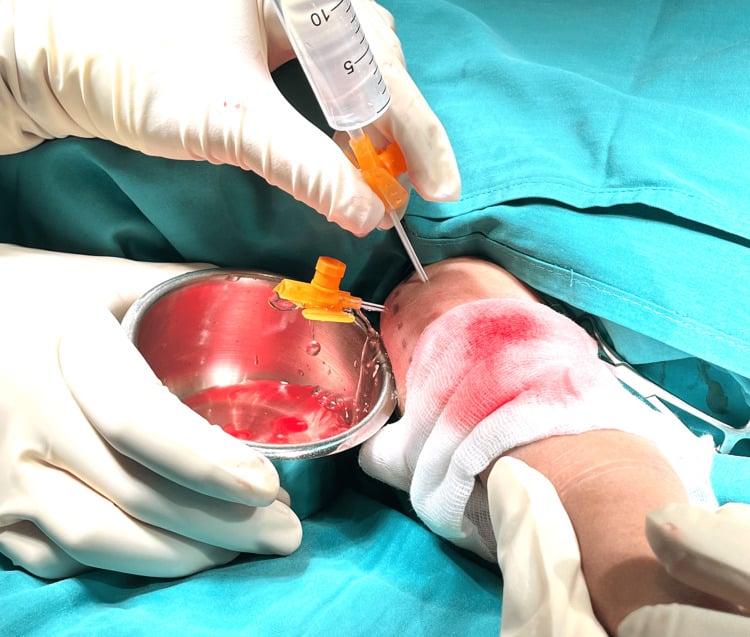 Operative close-up of minimally invasive paediatric shoulder-joint washout using two cannulas.