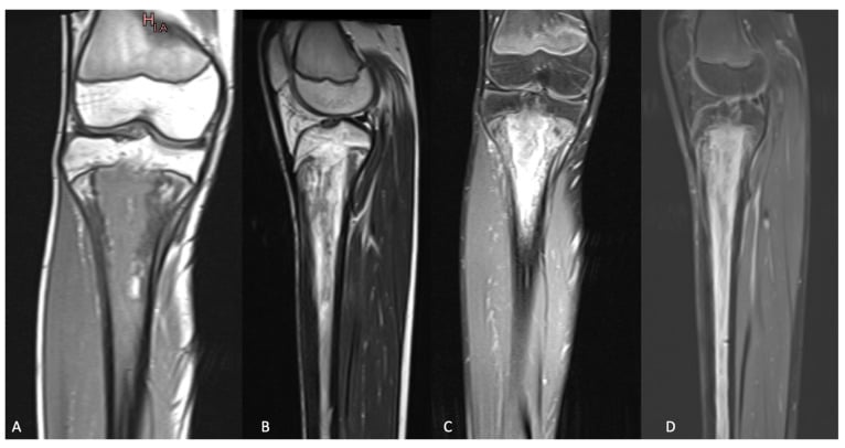 Four coronal and sagittal knee MRI sequences showing proximal tibial metaphyseal osteomyelitis extending across the physis.