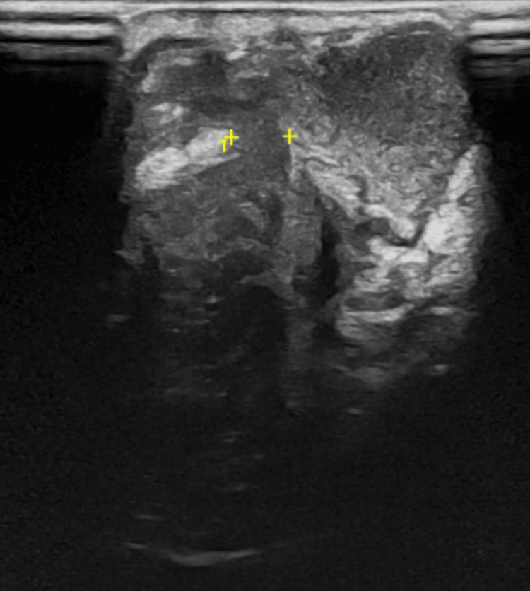 Wrist ultrasound showing an abscess tract extending through deep tissues into the joint with echogenic intra-articular material.