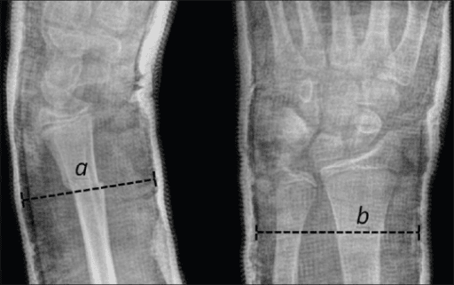 Radiographic cast index measurement for paediatric forearm immobilisation