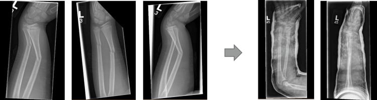 AP and lateral paediatric distal radius and ulna radiographs before and after closed manipulation