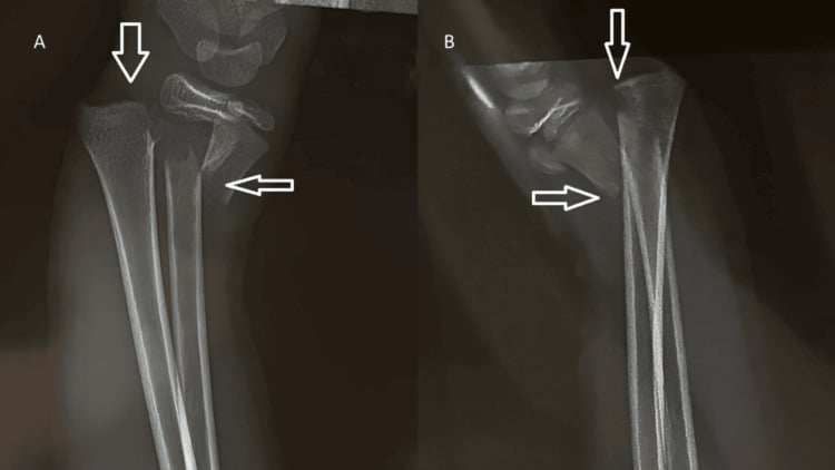 AP and lateral wrist radiographs showing complete metaphyseal fractures of the distal radius and ulna in a child