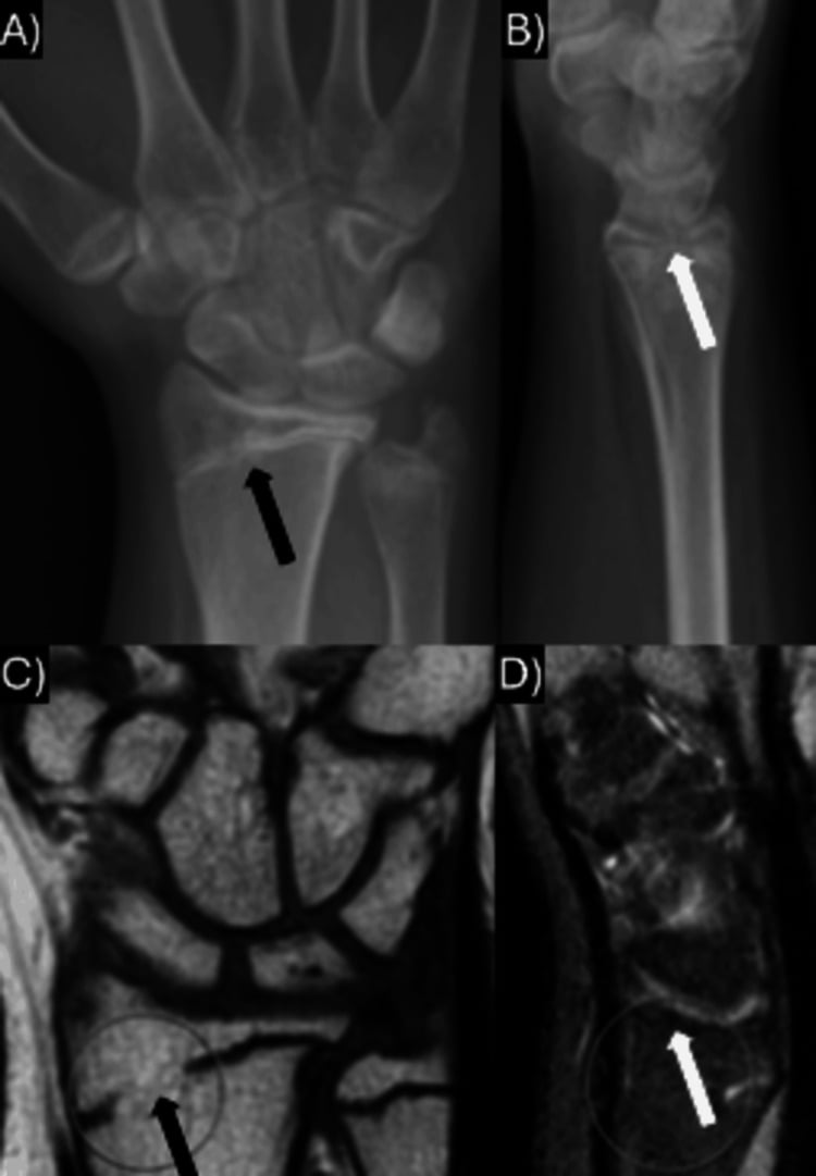 Follow-up wrist radiographs and MRI showing a distal radial physeal bar with reduced radial inclination