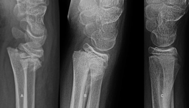 Serial lateral wrist radiographs showing remodelling of dorsal distal radial physeal angulation over six months