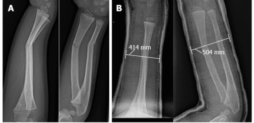 Paediatric forearm fracture cast index example