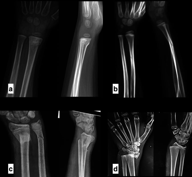 AP and lateral radiographs comparing buckle, minimally angulated, completely displaced and physeal paediatric distal radius fracture patterns