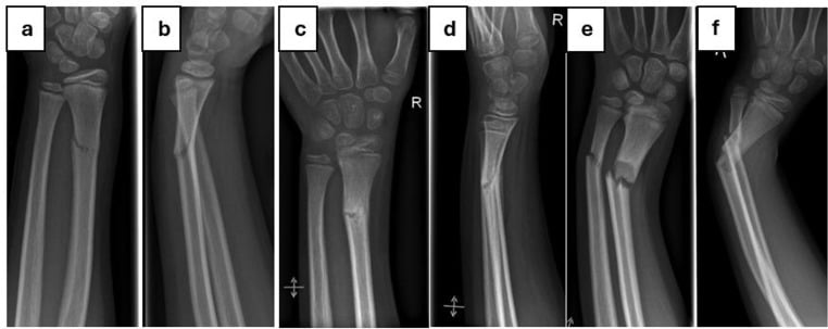 Serial AP and lateral radiographs of a paediatric distal radius greenstick fracture