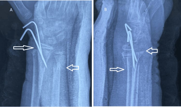 Immediate postoperative AP and lateral radiographs showing percutaneous Kirschner-wire fixation of a paediatric distal radius fracture