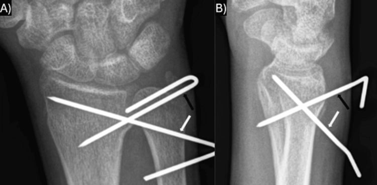 AP and lateral wrist radiographs showing crossed percutaneous pins for a distal radial physeal fracture after loss of reduction