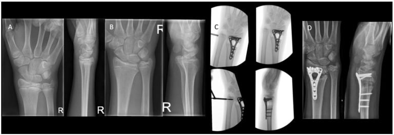 Serial wrist radiographs showing premature distal radial physeal closure, progressive ulnar-positive variance and corrective surgery