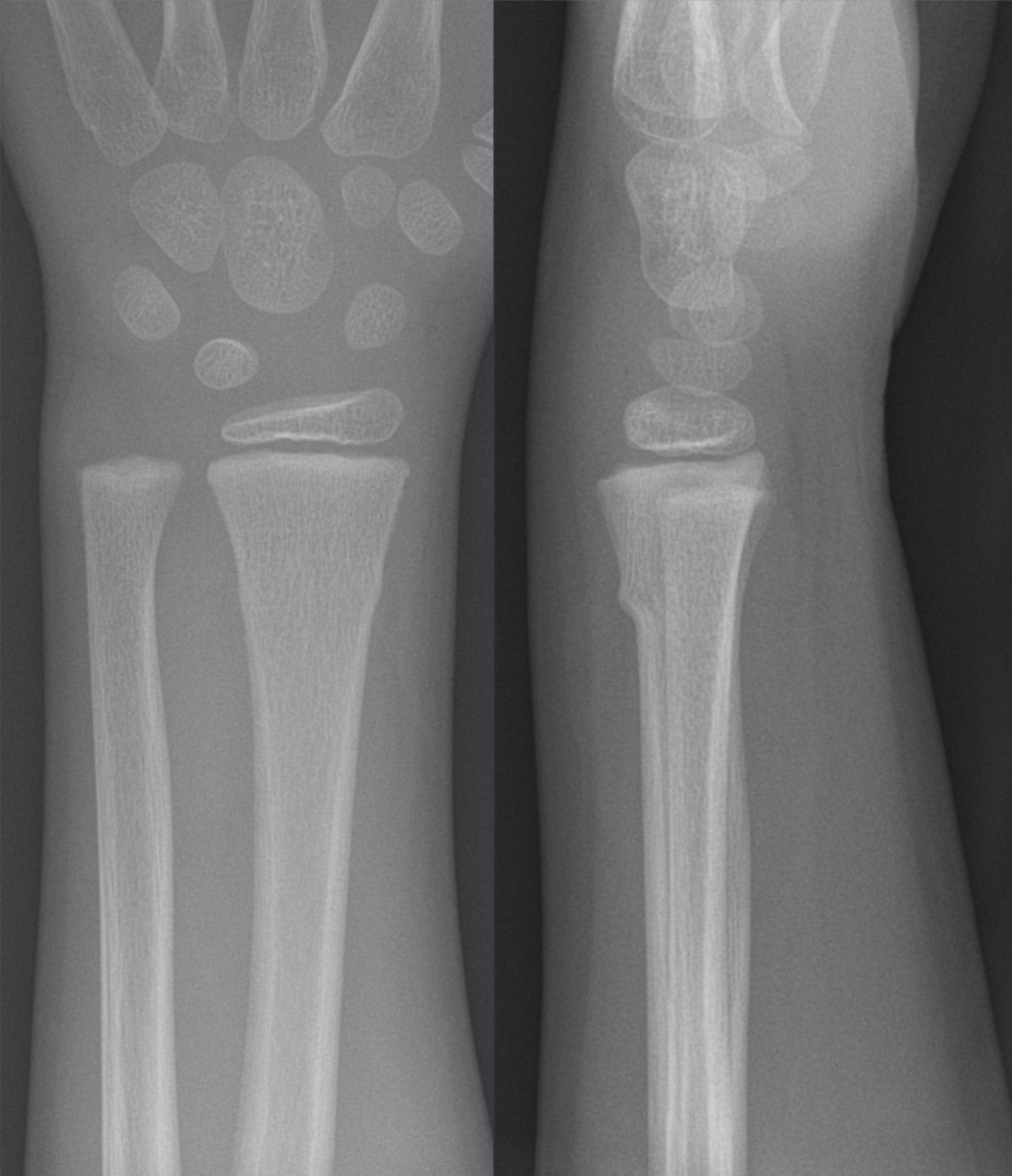 AP and lateral wrist radiographs of a torus (buckle) fracture of the distal radius in a 6-year-old child
