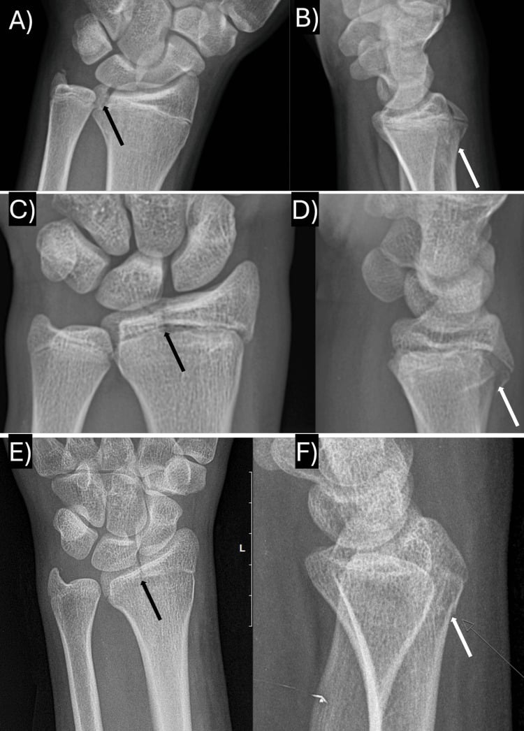 AP and lateral wrist radiographs showing transitional distal radius fractures with Salter-Harris III and II components