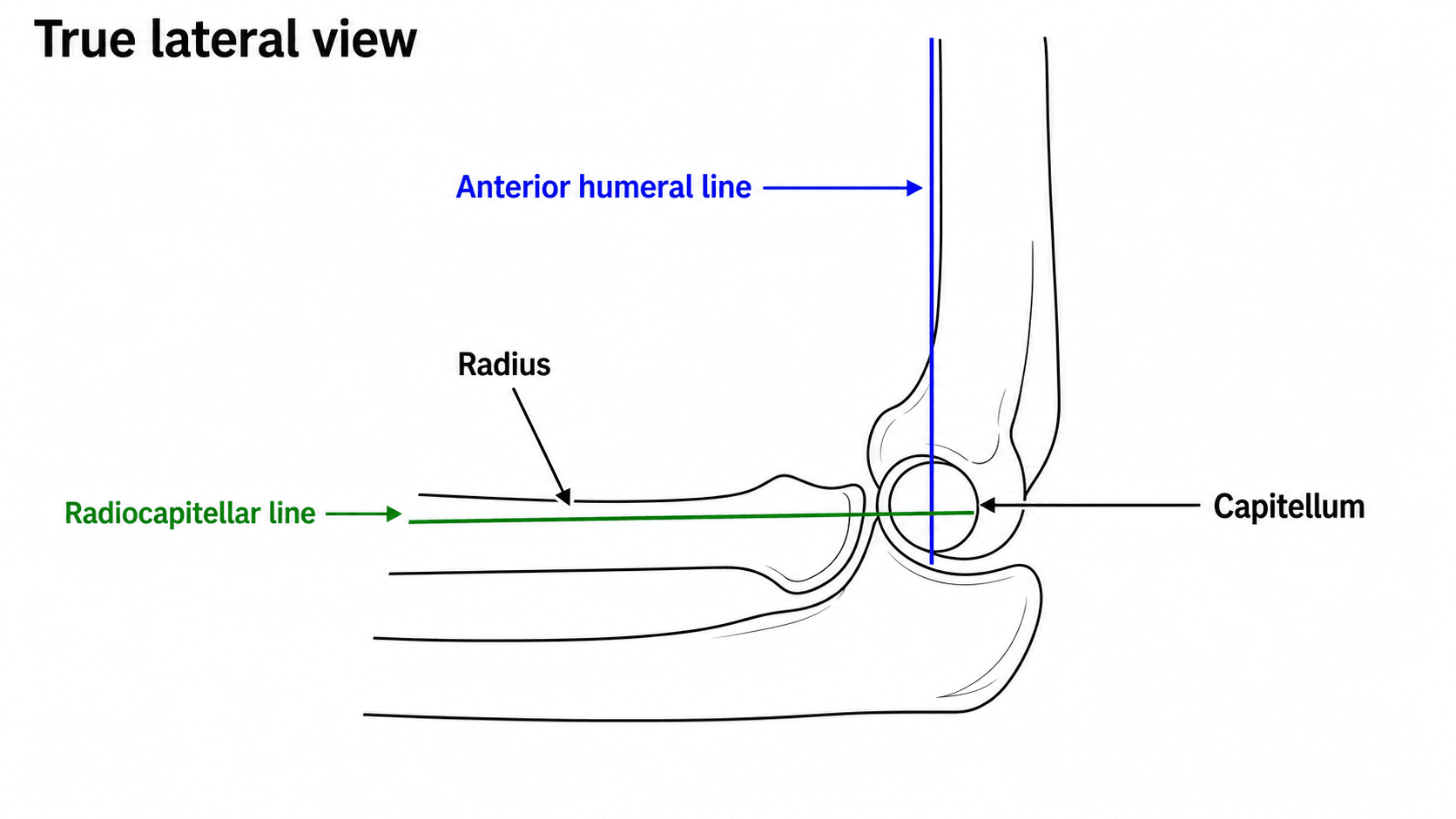 Paediatric elbow radiology lines diagram
