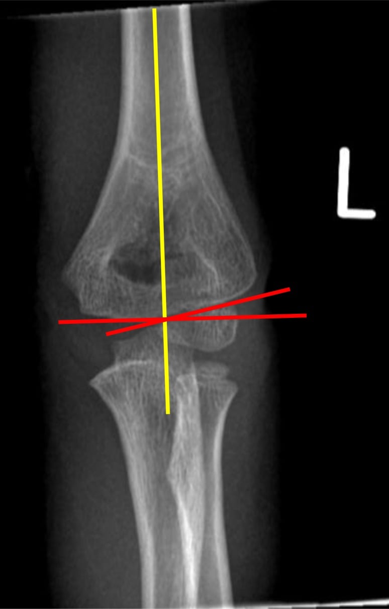 Anteroposterior paediatric elbow radiograph with the humeral shaft axis and lateral condylar physeal line drawn to form Baumann angle.
