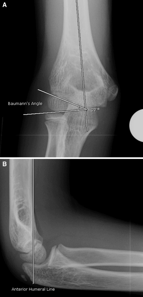 Baumann angle reference image in paediatric supracondylar fracture assessment