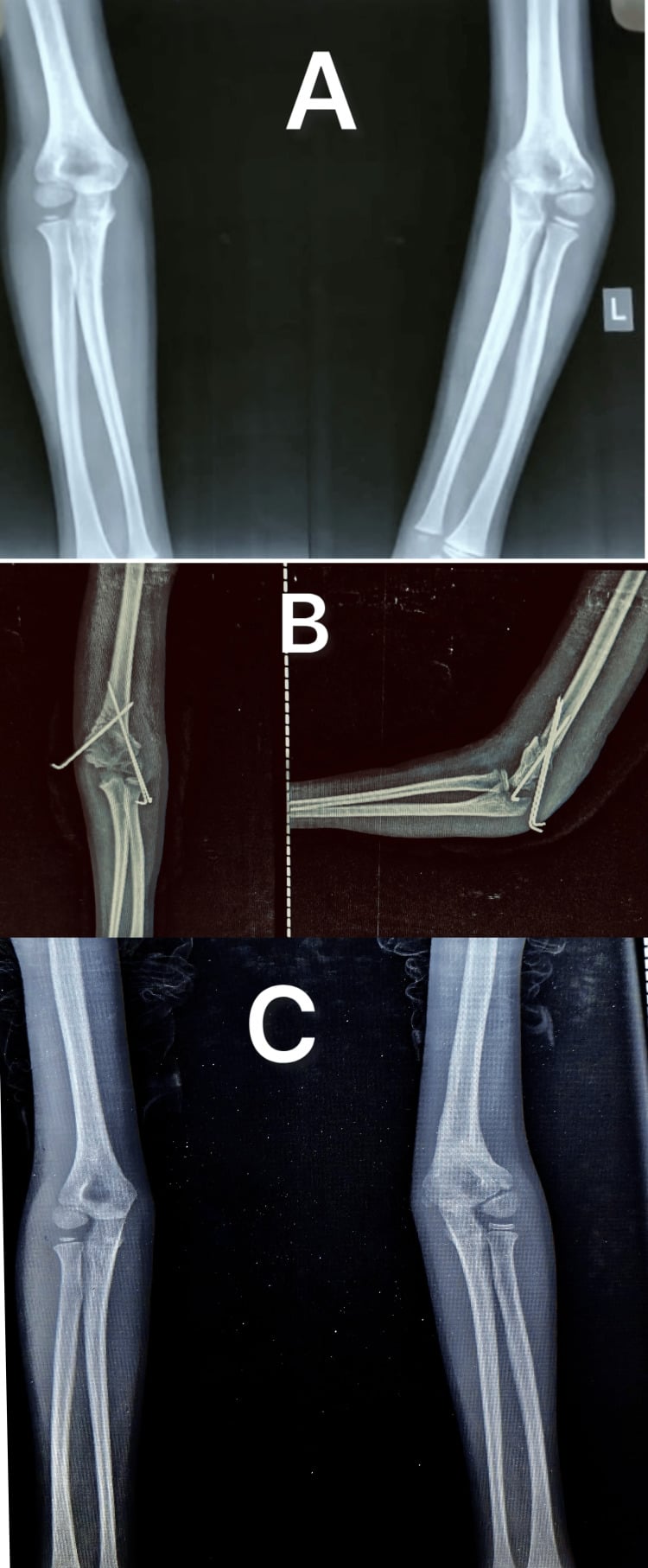 Serial paediatric elbow radiographs showing post-traumatic cubitus varus, corrective dome osteotomy fixation and healed alignment.