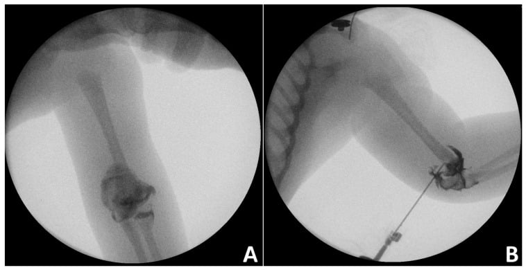 Anteroposterior and lateral intraoperative elbow arthrograms outlining the unossified distal humeral epiphysis in an infant with physeal separation.
