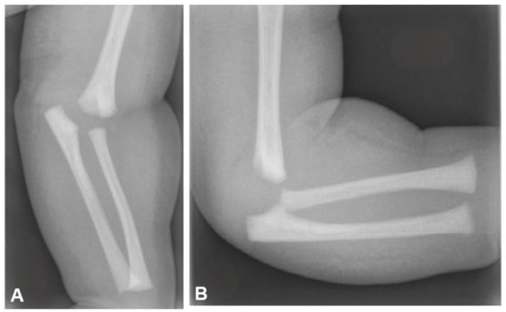 Anteroposterior and lateral infant elbow radiographs showing distal humeral physeal separation before secondary ossification centres are visible.