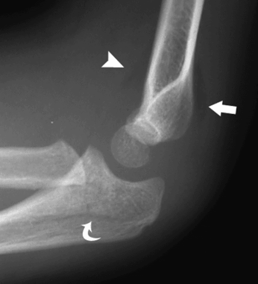 Annotated lateral elbow image showing fat pad signs