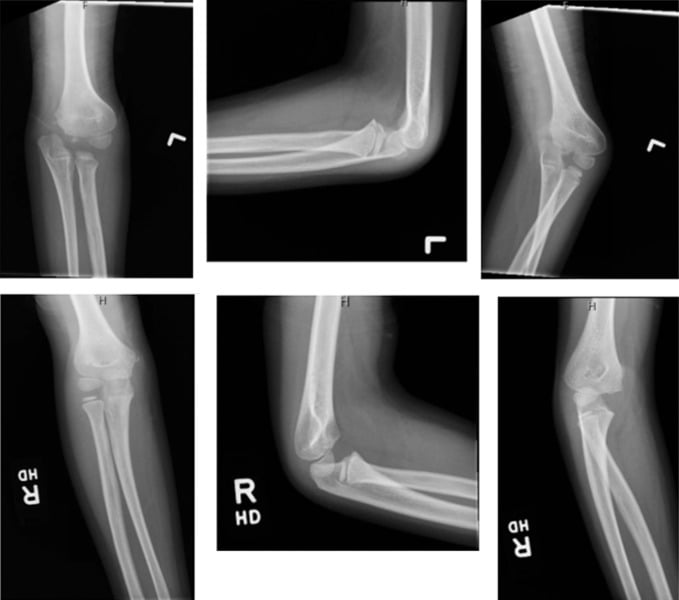 Bilateral comparison elbow radiographs showing trochlear collapse and fishtail deformity years after a paediatric lateral condyle fracture.