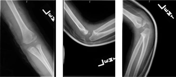 Anteroposterior, lateral and internal oblique paediatric elbow radiographs showing a minimally displaced lateral condyle fracture.