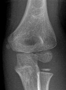 Anteroposterior paediatric elbow radiograph showing an avulsed medial epicondyle fragment incarcerated within the joint.