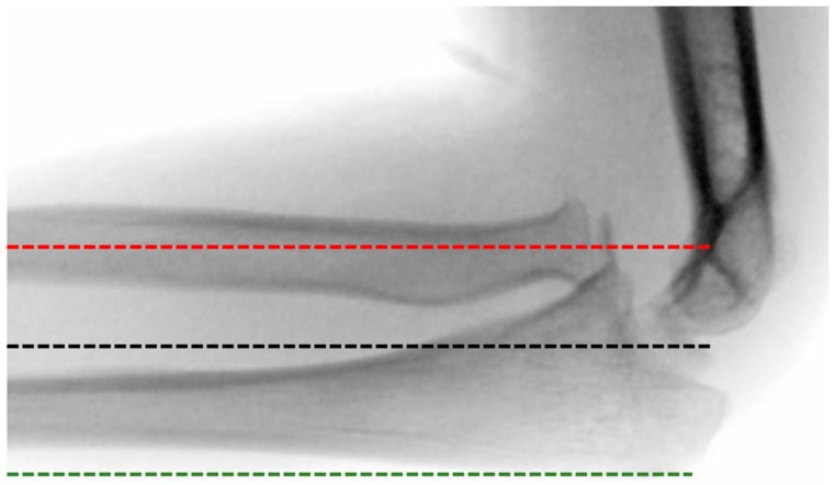 Lateral paediatric elbow radiograph showing a radial-axis line missing the capitellum in a chronic Monteggia lesion.