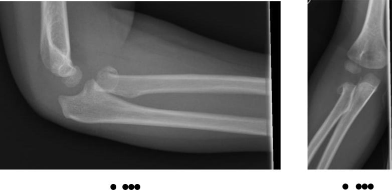 Lateral and anteroposterior paediatric elbow radiographs showing a severely displaced radial neck fracture.
