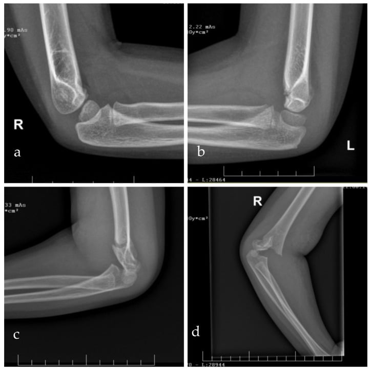 Four lateral paediatric elbow radiographs showing modified Gartland type I, IIA, IIB and III supracondylar humerus fractures.