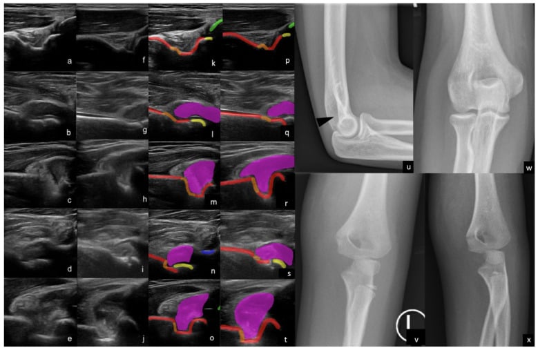 Paediatric elbow two-dimensional and three-dimensional ultrasound examples with labelled humerus, fracture, ossification centres, radius, ulna and effusion beside reference radiographs.