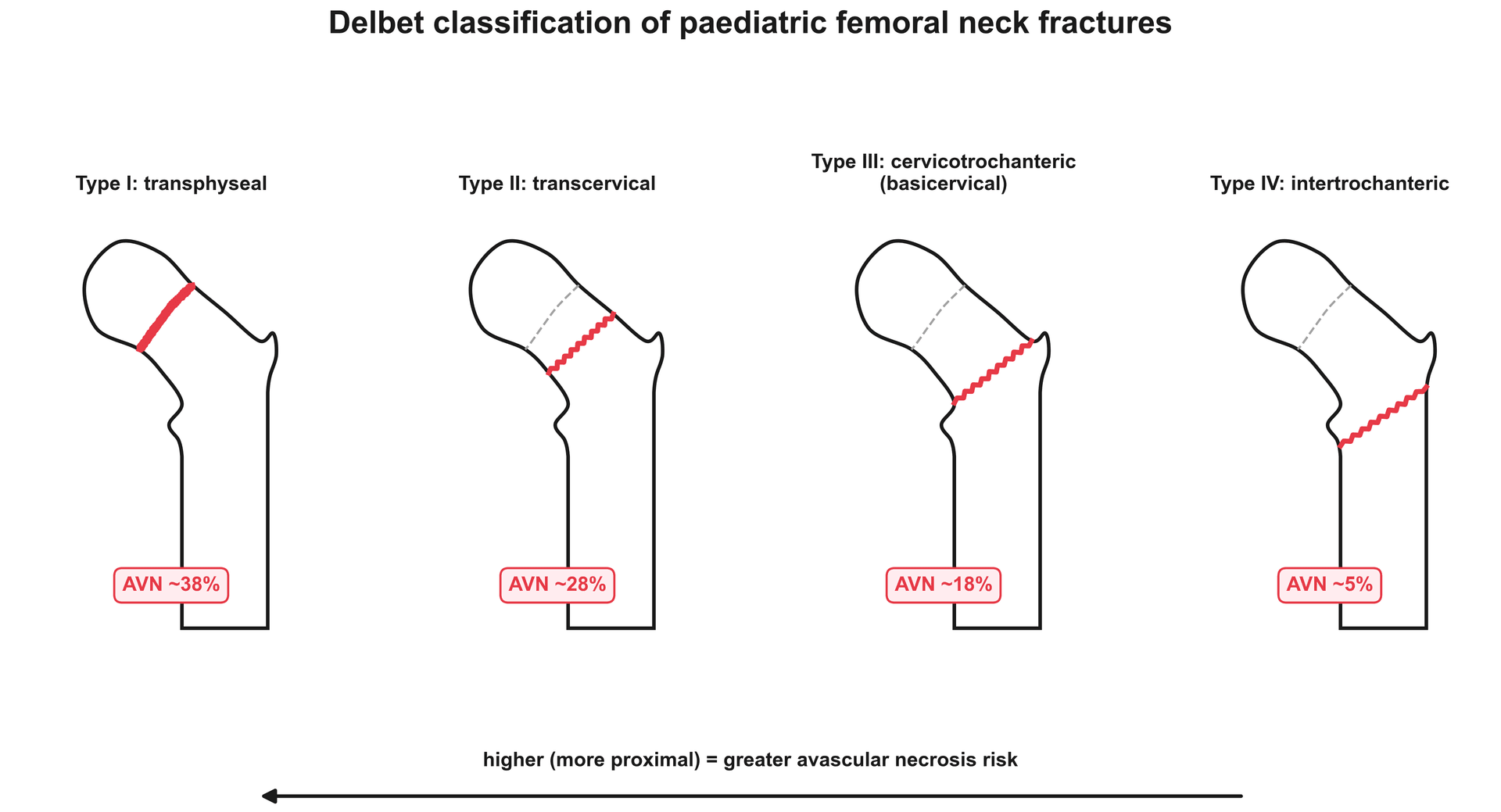 Diagram of the four Delbet types of paediatric femoral neck fracture with avascular necrosis risk