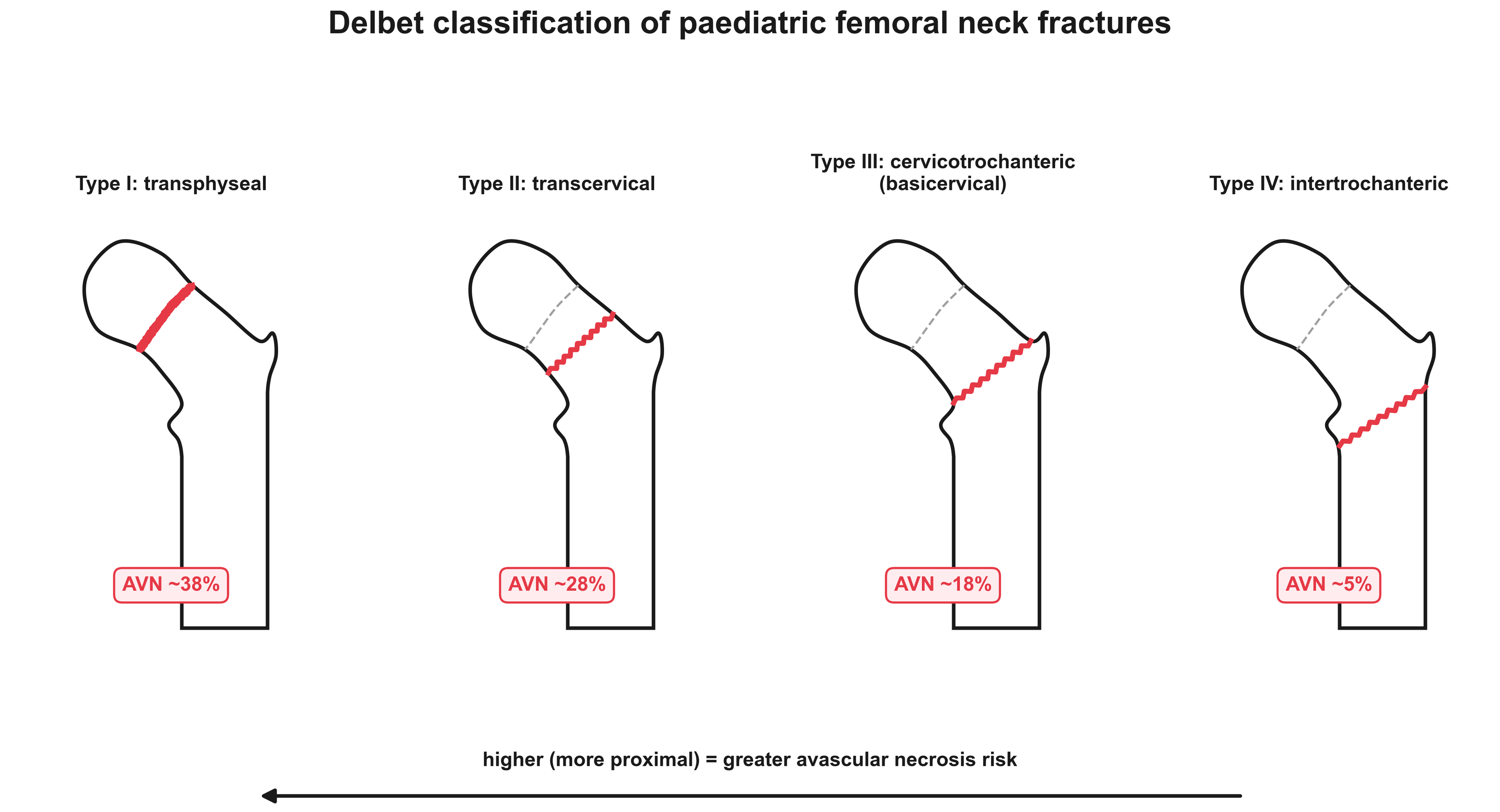 Diagram of the four Delbet types of paediatric femoral neck fracture with avascular necrosis risk