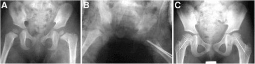Representative paediatric femoral neck fracture fixation radiograph