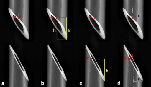 Radiographic measurement technique relevant to paediatric femur malrotation assessment