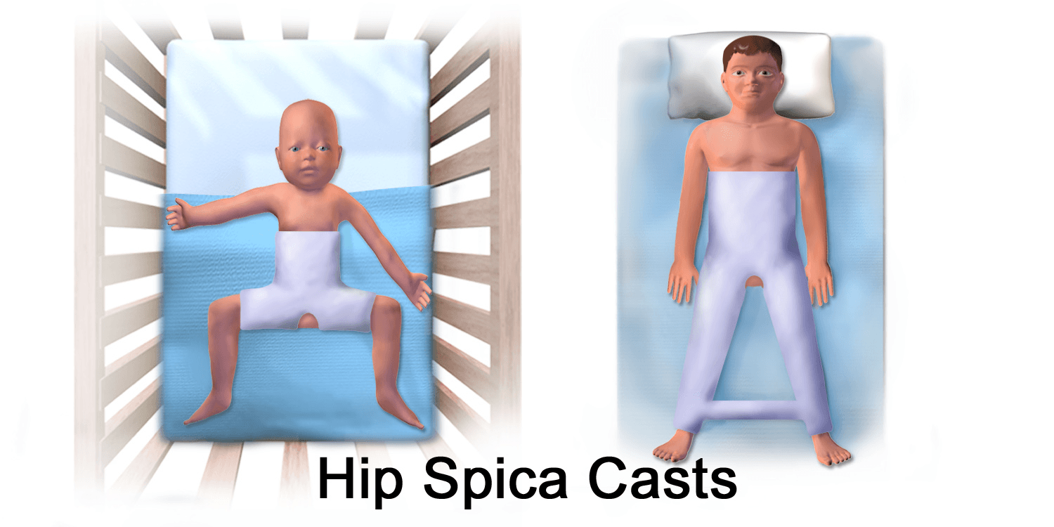 Illustration of hip spica casts on an infant in a crib and an older child, encasing the trunk and affected leg