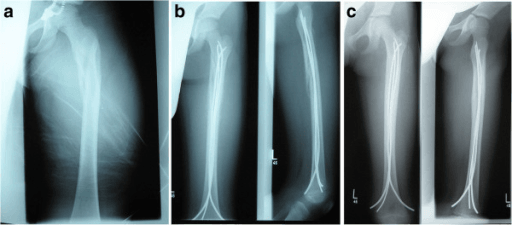 Paediatric femoral shaft fracture radiographs and healing progression